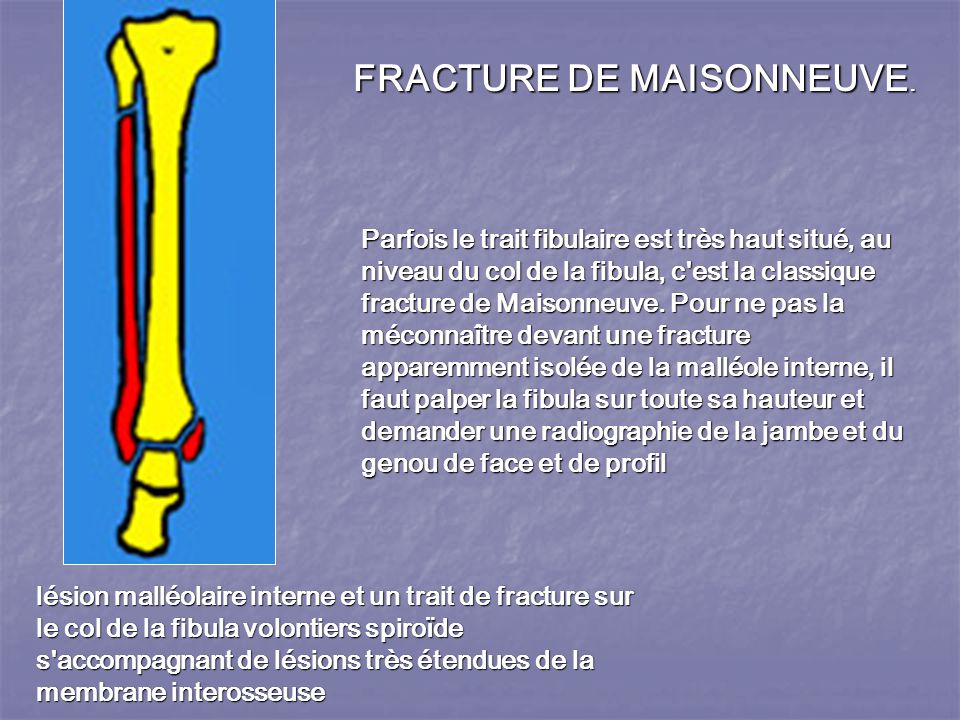 LES FRACTURES MALLEOLAIRES ppt video online t l charger